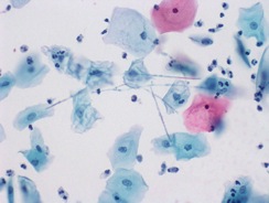 Candida Figure 1